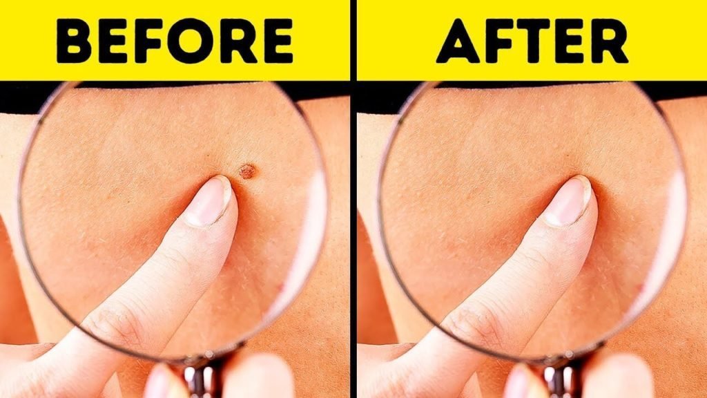 Solution For Unwanted Moles & Pesky Skin Tags