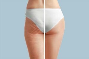 Worried About Cellulite? Try These Helpful Hints!